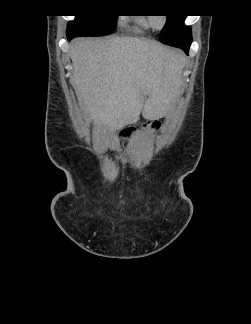 Adrenal myelolipoma - bilateral (Radiopaedia 74805-85810 Coronal C+ portal venous phase 231).jpg