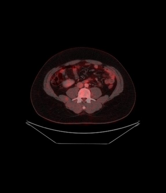 Adrenocortical carcinoma (Radiopaedia 80134-93440 ِAxial 198).jpg