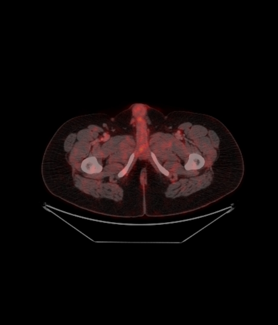 Adrenocortical carcinoma (Radiopaedia 80134-93440 ِAxial 266).jpg