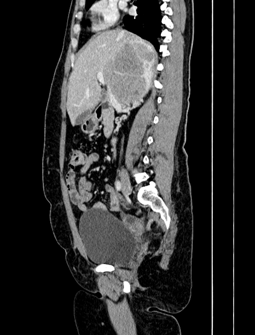 Adrenocortical carcinoma (Radiopaedia 87281-103569 Sagittal C+ portal venous phase 117).jpg