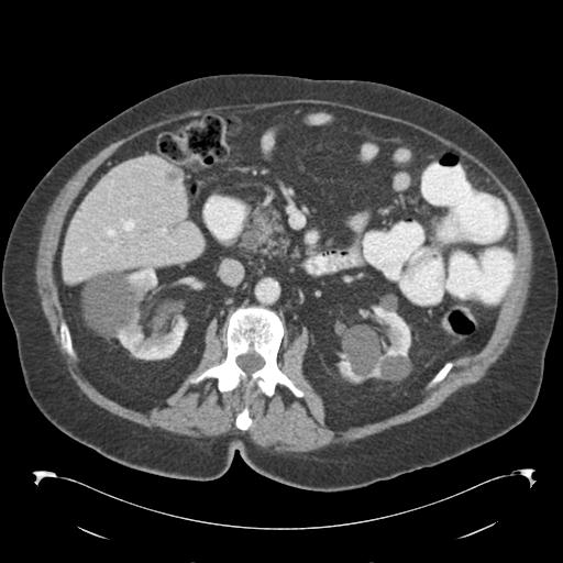 Adult ileal intussusception with secondary obstruction (Radiopaedia 30395-31051 Axial C+ portal venous phase 31).jpg