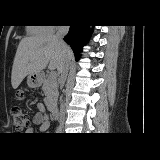Adult polycystic kidney disease (Radiopaedia 59075-66368 Sagittal non-contrast 37).jpg