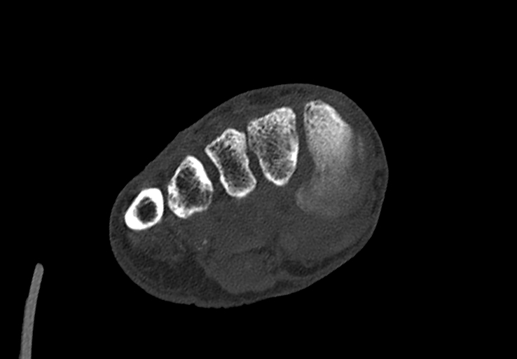 Advanced osteomyelitis due to open metatarsal fracture (Radiopaedia 83891-99095 Axial bone window 28).jpg