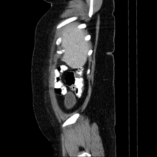 File:Afferent loop syndrome - secondary to incarcerated trocar site hernia (Radiopaedia 82959-97305 Sagittal C+ portal venous phase 138).jpg