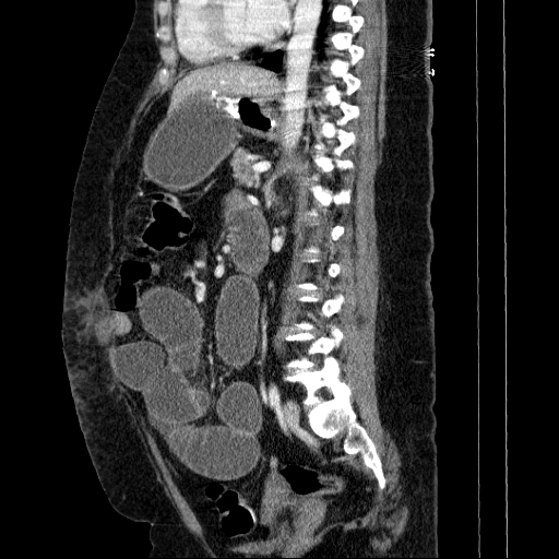Afferent loop syndrome - secondary to incarcerated trocar site hernia (Radiopaedia 82959-97305 Sagittal C+ portal venous phase 66).jpg