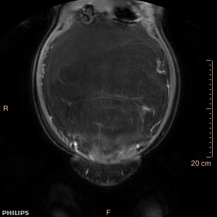Aggressive angiomyxoma (Radiopaedia 73343-84093 G 23).jpg