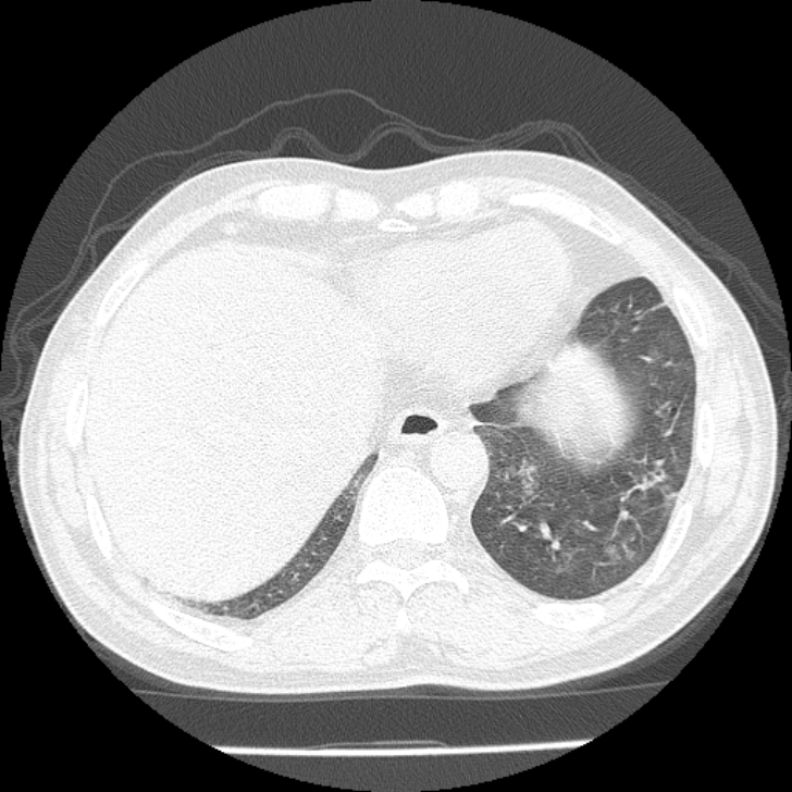 Airway foreign body in adult (Radiopaedia 85907-101779 Axial lung window 155).jpg