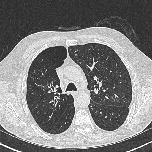 Allergic bronchopulmonary aspergillosis (Radiopaedia 44760-48571 Axial lung window 23).png