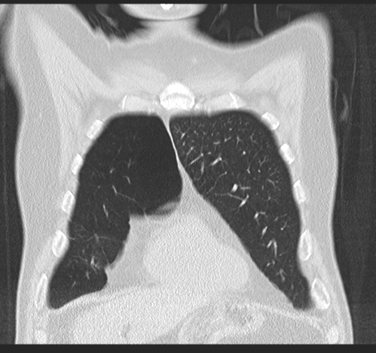 Allergic bronchopulmonary aspergillosis (Radiopaedia 44760-48571 Coronal lung window 15).png
