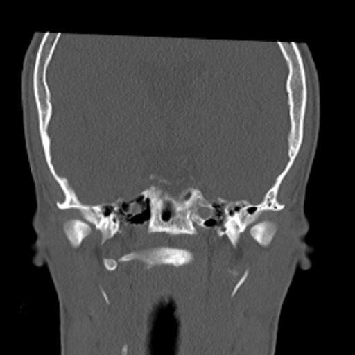 File:Allergic fungal sinusitis (Radiopaedia 29086-29455 Coronal bone window 2).jpg