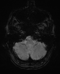 File:Alzheimer's disease- with Gerstmann syndrome and dressing apraxia (Radiopaedia 54882-61150 Axial SWI 5).png