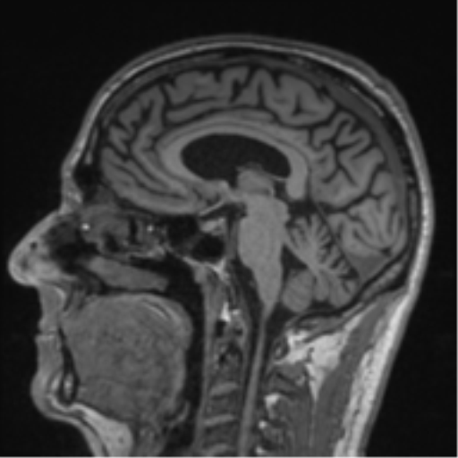 File:Alzheimer's disease- with Gerstmann syndrome and dressing apraxia (Radiopaedia 54882-61150 Sagittal T1 33).png