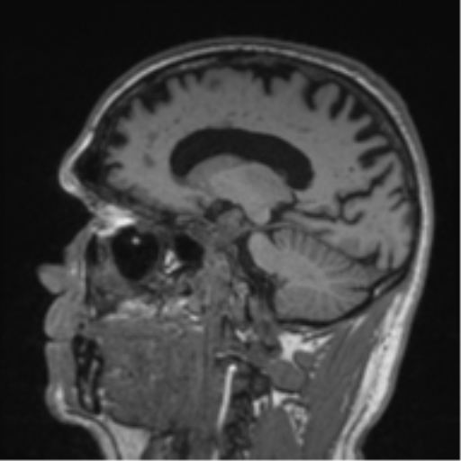 Alzheimer's disease- with Gerstmann syndrome and dressing apraxia (Radiopaedia 54882-61150 Sagittal T1 43).png