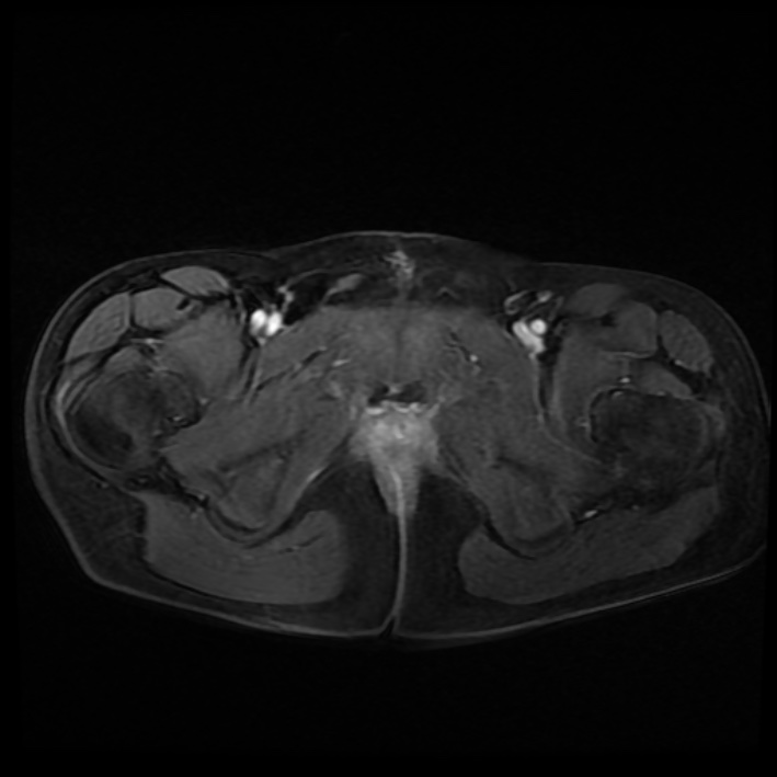 Ambiguous genitalia (Radiopaedia 69686-79643 Axial T1 C+ fat sat 46).jpg