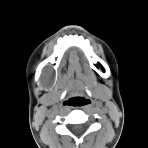 File:Ameloblastoma (Radiopaedia 26645-26793 Axial C+ delayed 12).jpg