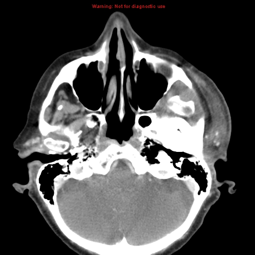 Ameloblastoma (Radiopaedia 27437-27631 A 10).jpg