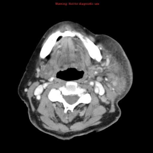 Ameloblastoma (Radiopaedia 27437-27631 A 49).jpg