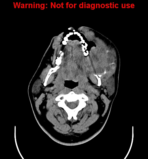 File:Ameloblastoma (Radiopaedia 33126-34164 A 7).jpg