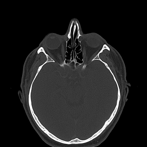 Ameloblastoma (Radiopaedia 38520-40623 Axial bone window 4).png
