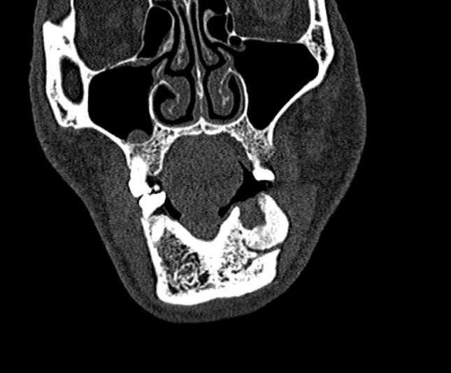 Ameloblastoma (Radiopaedia 51921-57766 Coronal bone window 54).jpg