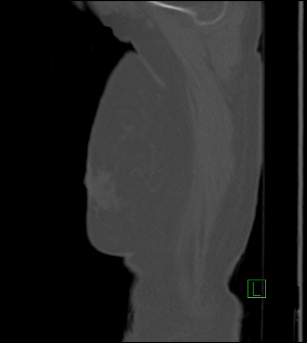 Amiodarone deposition in the liver (Radiopaedia 77587-89780 Sagittal bone window 95).jpg