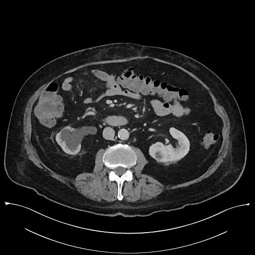Ampullary adenocarcinoma (Radiopaedia 59373-66737 A 81).jpg