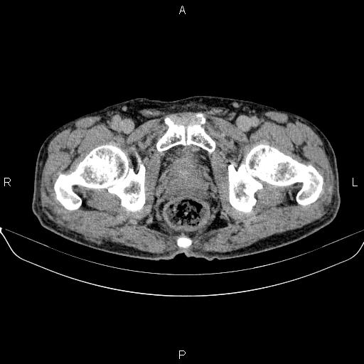 Ampullary adenocarcinoma (Radiopaedia 86093-102032 Axial C+ delayed 104).jpg