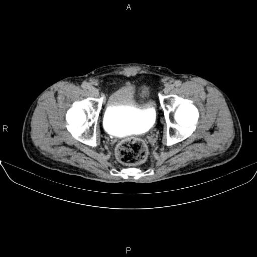 Ampullary adenocarcinoma (Radiopaedia 86093-102032 Axial C+ delayed 96).jpg