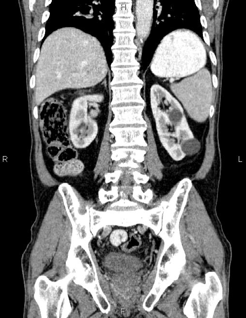 Ampullary adenocarcinoma (Radiopaedia 86093-102032 C 46).jpg