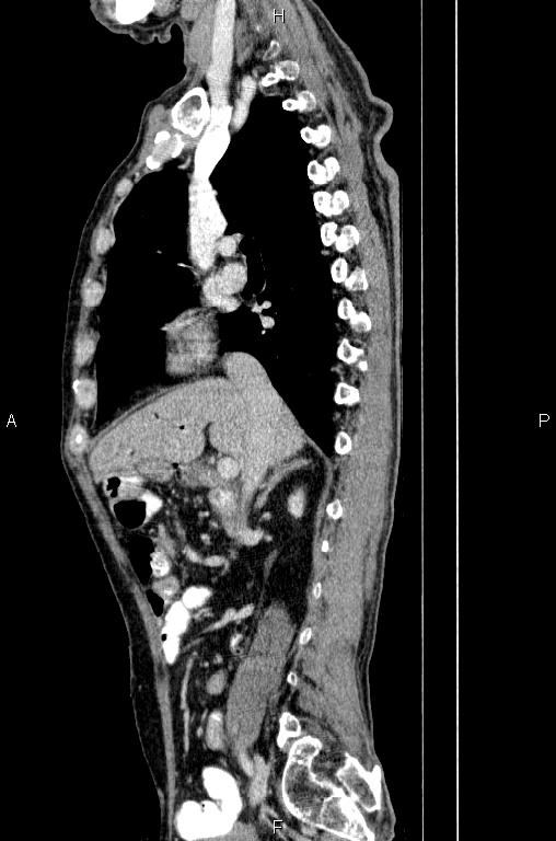 Ampullary adenocarcinoma (Radiopaedia 86093-102033 E 35).jpg