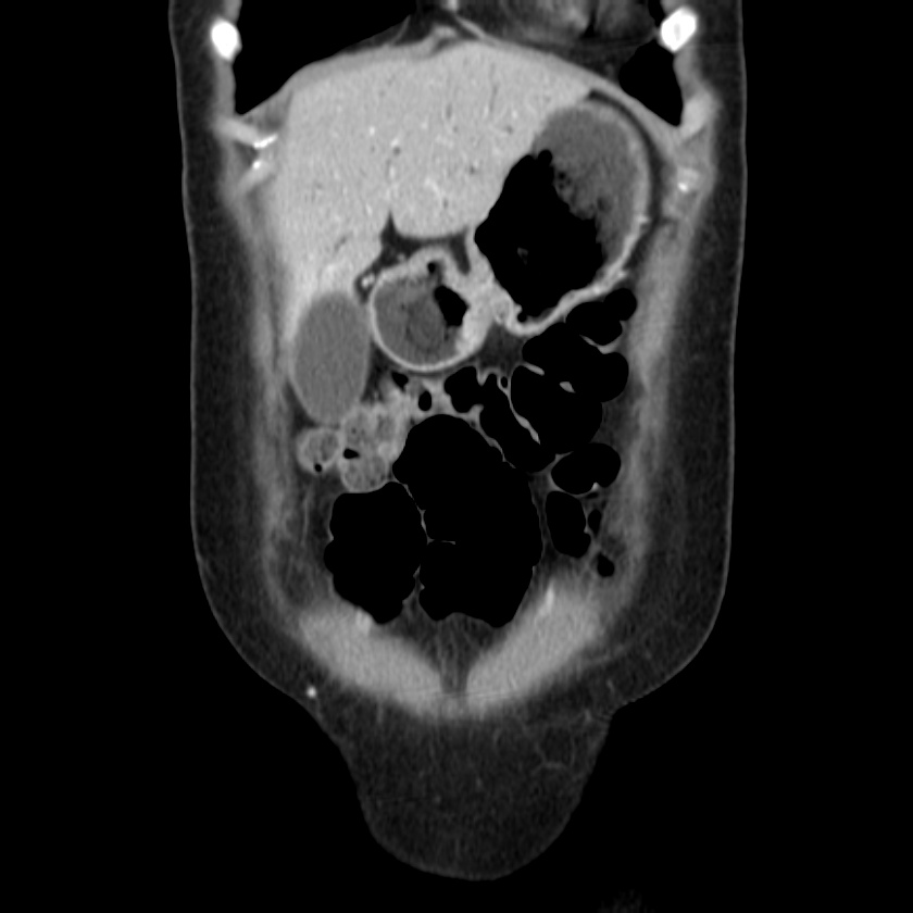 Ampullary tumor (Radiopaedia 22787-22816 E 12).jpg