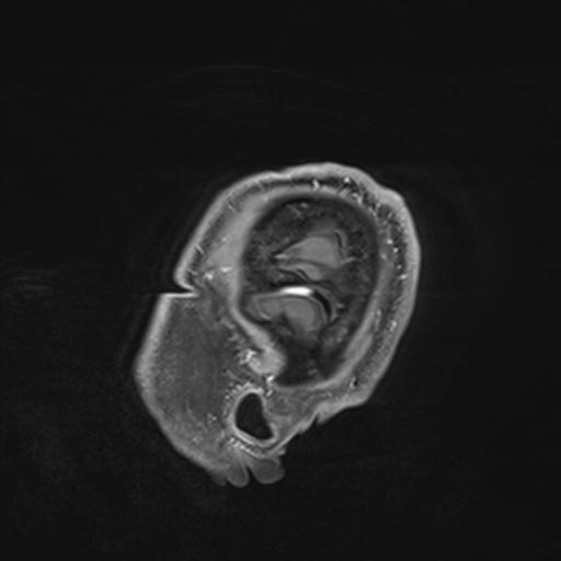 Amyloid angiopathy with inflammation (Radiopaedia 30360-31002 M 8).jpg