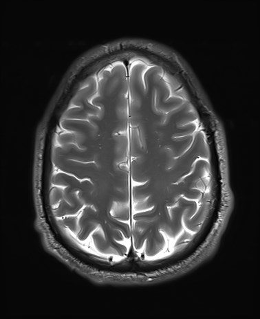 File:Amyotrophic lateral sclerosis (Radiopaedia 87352-103658 Axial T2 23).jpg