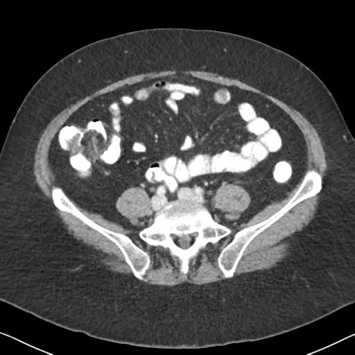 Anal adenocarcinoma - tumor regression grade 1 (Radiopaedia 31358-32103 Axial POST 49).jpg