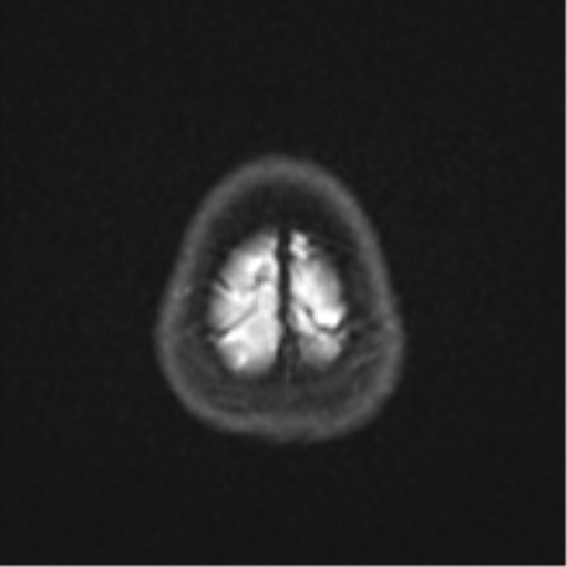 Anaplastic astroblastoma (Radiopaedia 55666-62194 Axial DWI 27).png