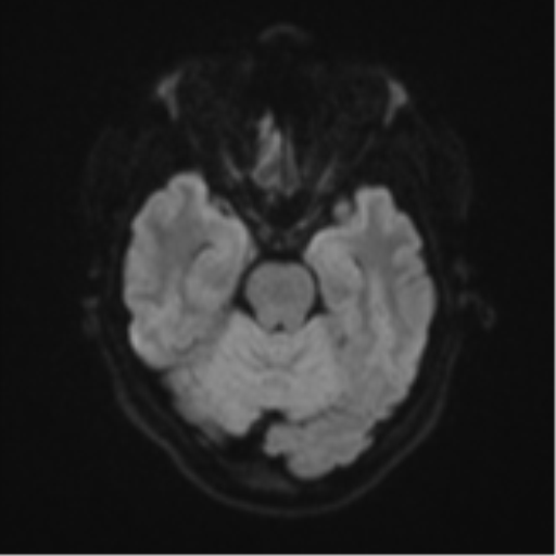 Anaplastic astroblastoma (Radiopaedia 55666-62194 Axial DWI 38).png