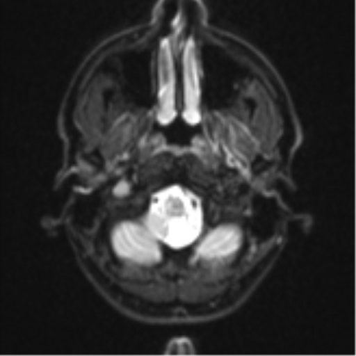 Anaplastic astrocytoma (Radiopaedia 57768-64731 Axial DWI 2).png