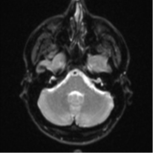 File:Anaplastic astrocytoma (Radiopaedia 57768-64731 Axial DWI 6).png