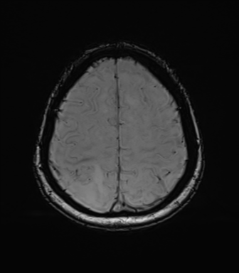 Anaplastic astrocytoma (Radiopaedia 86943-103160 Axial SWI 71).png