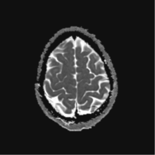 File:Anaplastic astrocytoma IDH mutant (Radiopaedia 50046-55341 Axial ADC 24).png