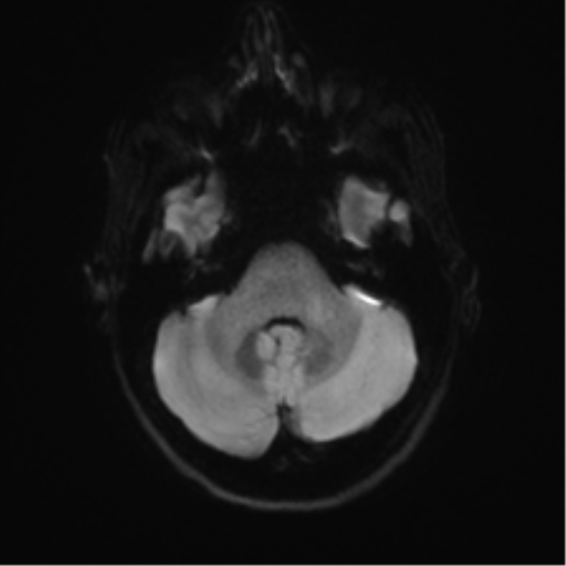 Anaplastic astrocytoma IDH mutant (Radiopaedia 50046-55341 Axial DWI 34).png