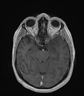Anaplastic astrocytoma IDH wild-type (Radiopaedia 49984-55273 Axial T1 C+ 22).png