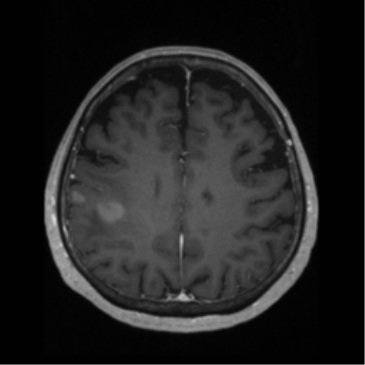 File:Anaplastic astrocytoma IDH wild-type (pseudoprogression) (Radiopaedia 42209-45276 Axial T1 C+ 100).png