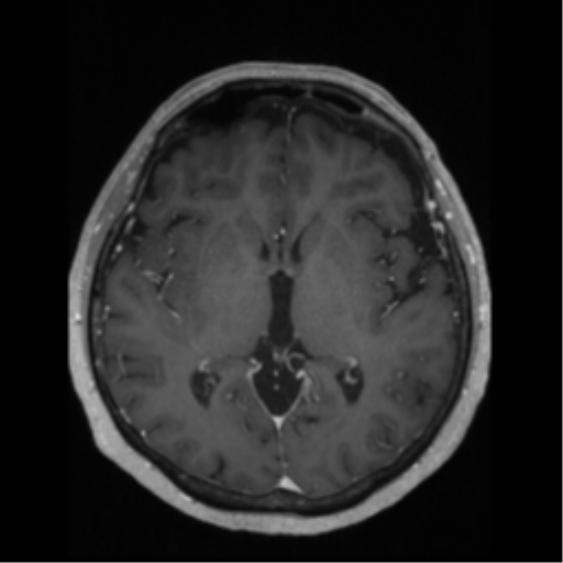 File:Anaplastic astrocytoma IDH wild-type (pseudoprogression) (Radiopaedia 42209-45276 Axial T1 C+ 76).png