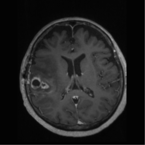 File:Anaplastic astrocytoma IDH wild-type (pseudoprogression) (Radiopaedia 42209-45277 Axial T1 C+ 72).png