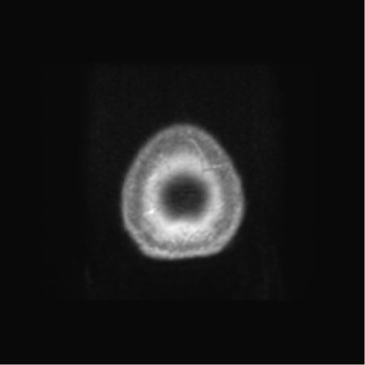 Anaplastic astrocytoma IDH wild-type (pseudoprogression) (Radiopaedia 42209-45279 Axial T1 C+ 144).png