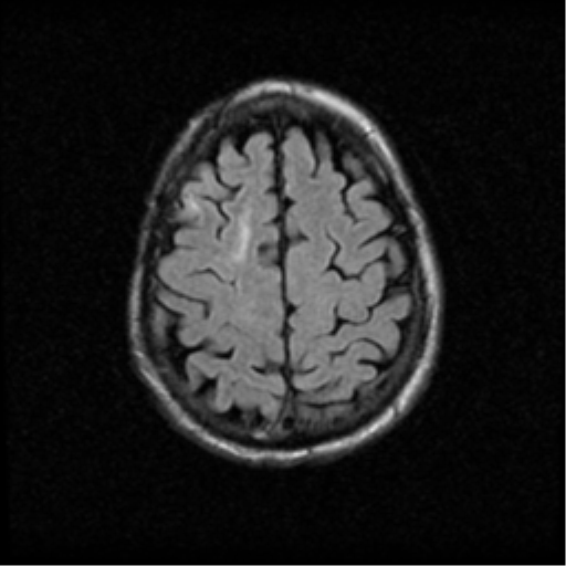 File:Anaplastic meningioma with recurrence (Radiopaedia 34452-35789 Axial FLAIR 19).png