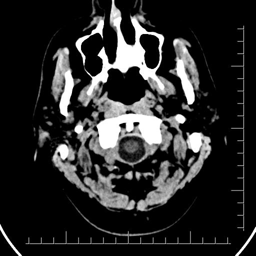 Aneurysm of posterior communicating artery (Radiopaedia 20188-20162 Axial non-contrast 1).jpg