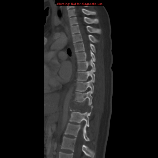 File:Aneurysmal bone cyst (Radiopaedia 9419-10102 Sagittal bone window 10).jpg