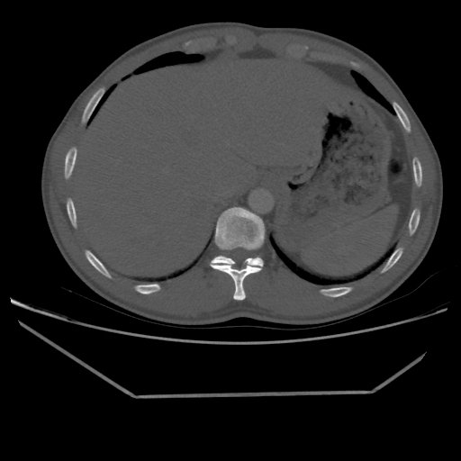 File:Aneurysmal bone cyst - rib (Radiopaedia 82167-96220 Axial bone window 221).jpg